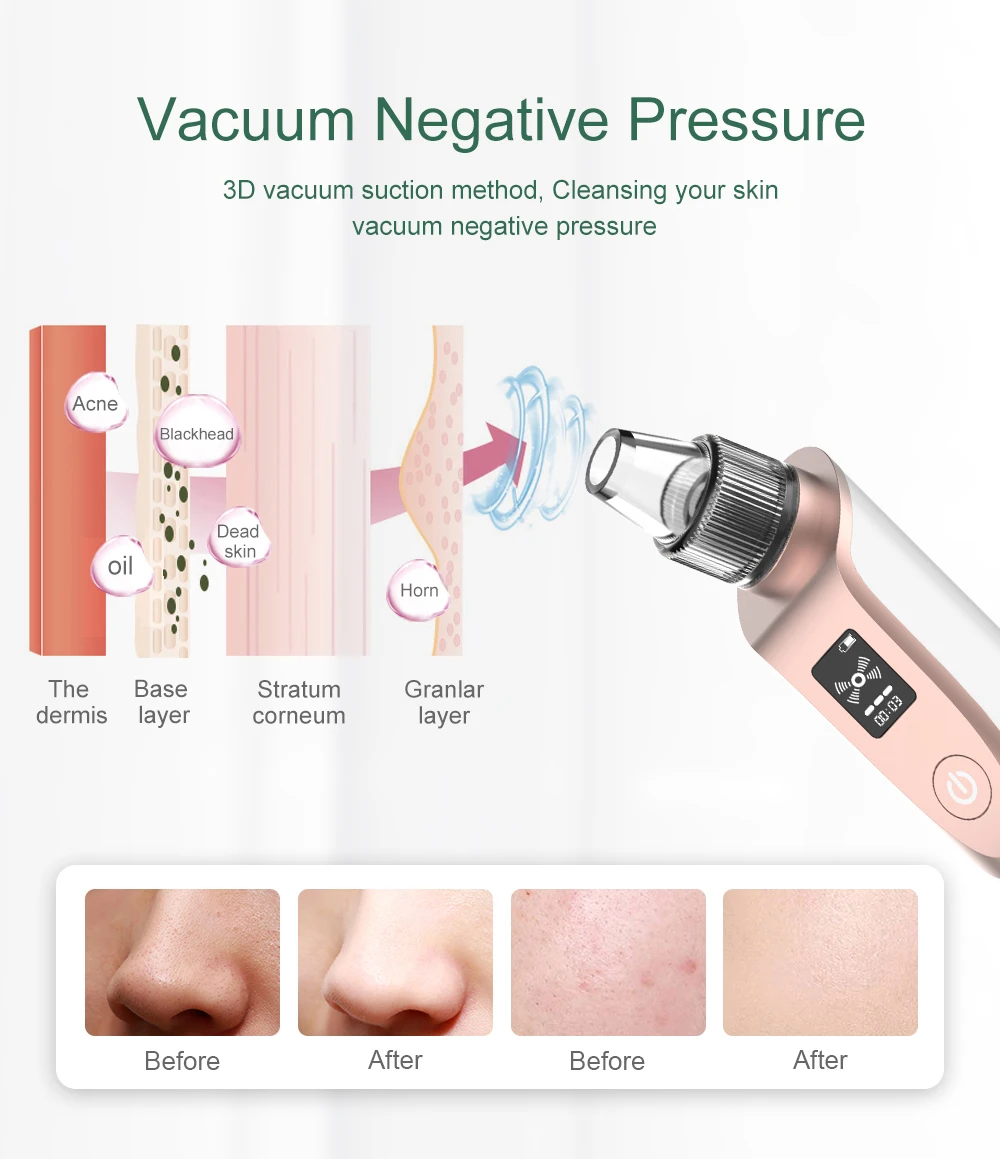 Removedor de Cravo Ferramentas de Cuidados Removedor de Cabeça Anlan Vácuo Pore Cleaner Comedões Acne Faciais Espinhas Comedão Extractor Remoção Preta 7 Beleza e saúde