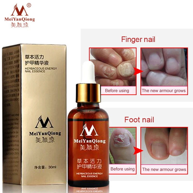 

Remedy For Nail Fungus Treatment Feet Care Essence Whitening Toe From Nail Foot Fungus Remove Gel Antifungal Onychomycosis