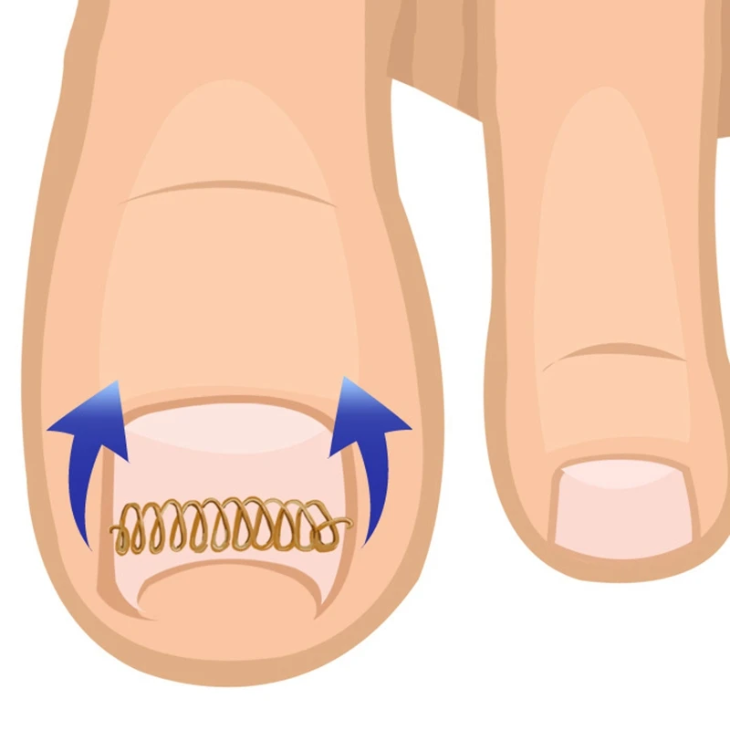 12 шт. вросший носок проволочный фиксатор для коррекции ногтей Педикюр Paronychia восстановление ногтей корректор Уход за ногами