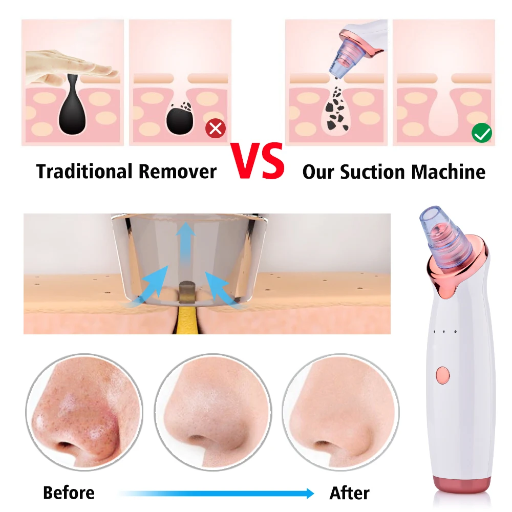 Blackhead Remover Acne Pimple Remover Tool Skin Face Vacuum Suction Pore Cleaner Skin Care Comedone Removal Facial Tools (4)