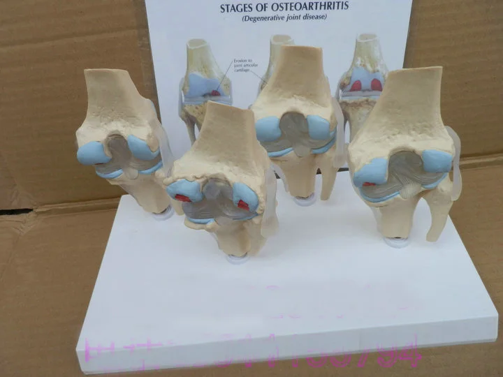 Pathology Knee Joint Model Abnormal State Lesions Skeleton Degenerative Disease | Канцтовары для офиса и дома