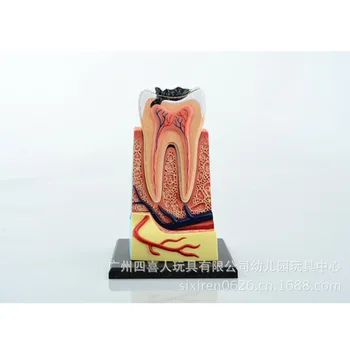 

High Quality NEW Denture Teeth Model 23 Pieces Caries Comparison Model, Tooth Decay Model,Dentist for Medical Science Teaching