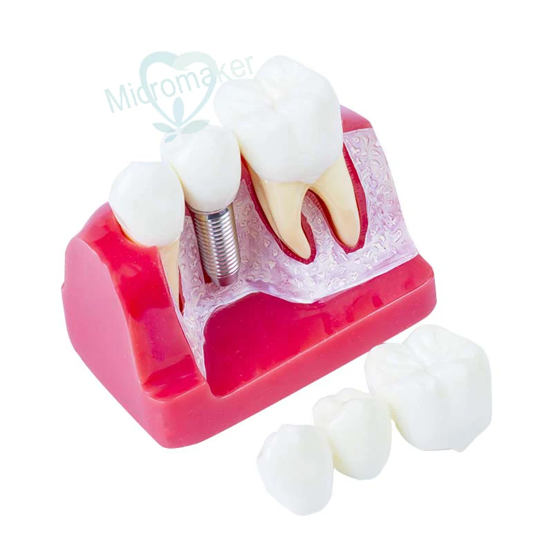 

1pc Dental Demonstration Teeth Model Implant Analysis Crown Bridge Teeth Model New