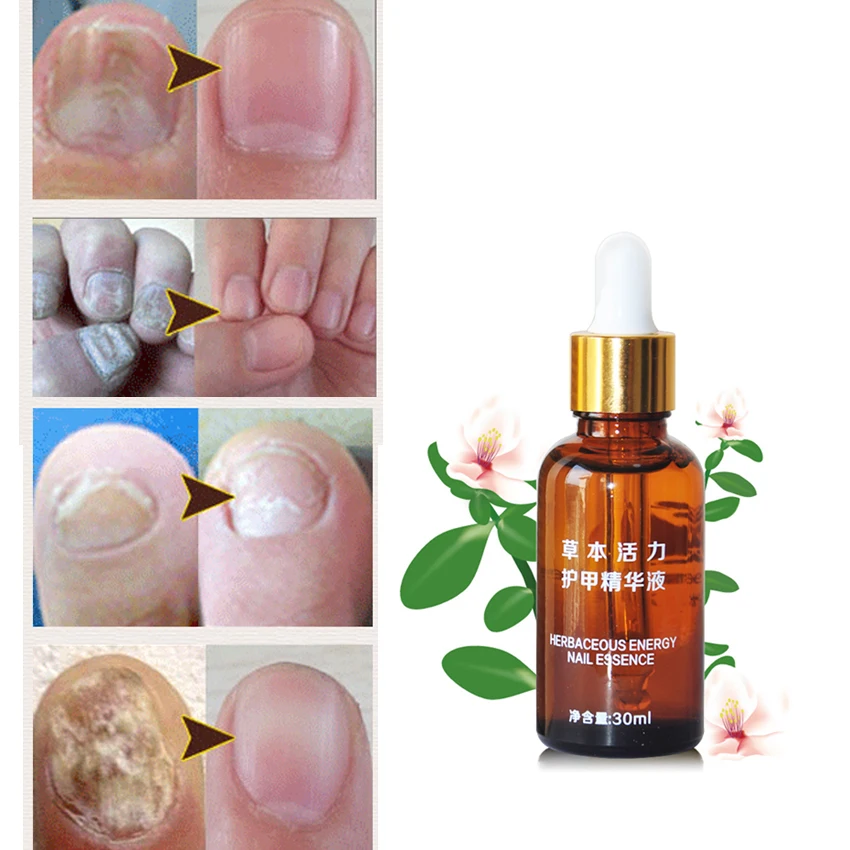 Hot Product Chinese Medicine Fungal Nail Treatment Essence Nail And