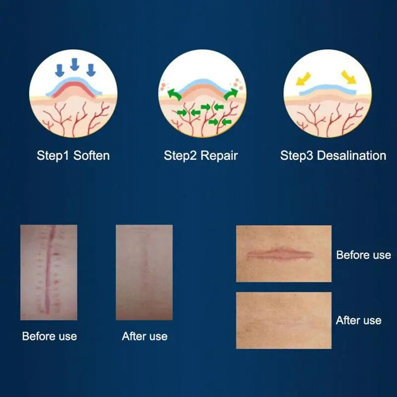 Медицинская Пластырь от шрамов силиконовая гелевая пластина для удаления следов от ран лечение гипертрофических келоидных шрамов