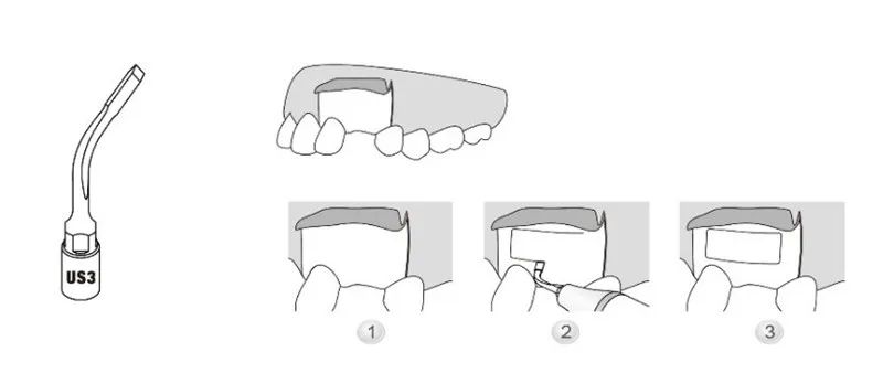 3 x US3 костная насадка для операций для высокоутонченного резки узких нежных костей в тонких регионах clareador Стоматологическая
