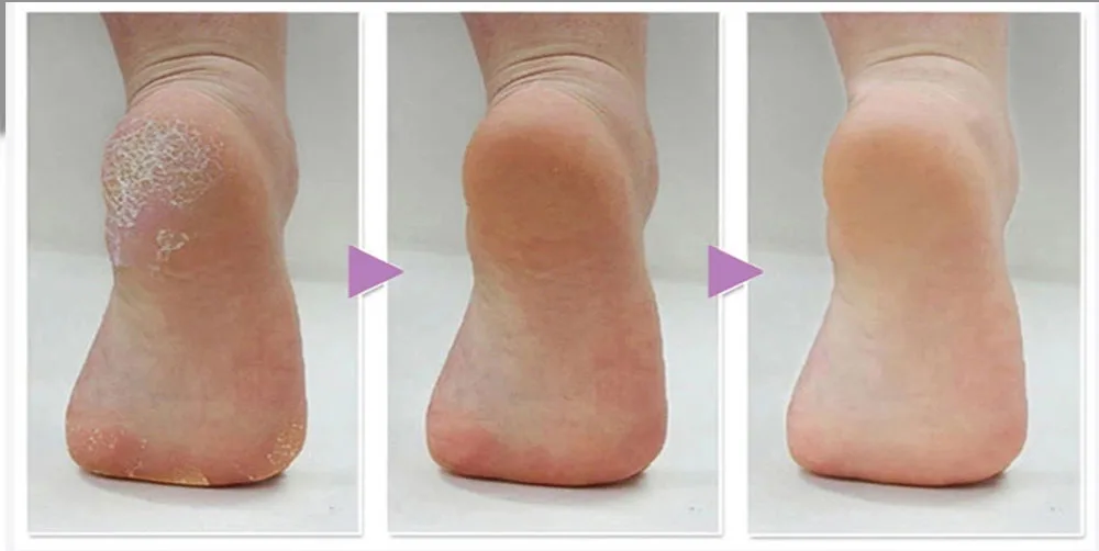 KIMISKY фиолетовый инструмент для ухода за ногами перезаряжаемые педикюр инструменты ног напильник удаление наростов средства ухода за кожей