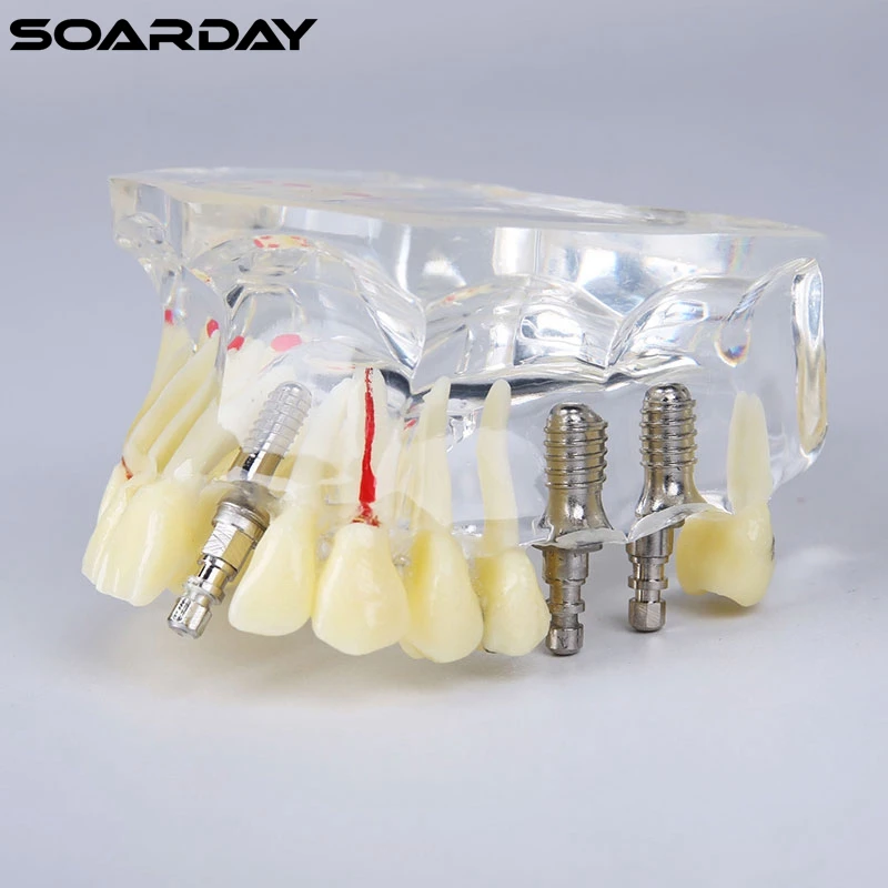 Implant-model-with-bridge-and-caries-1