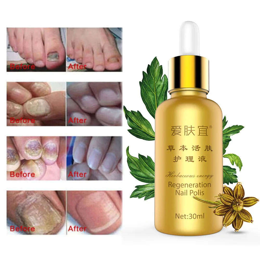 

30ML Anti Fungal Nail Treatment Toe Nail Finger Fungus Thickened Repair Solution Stencil Nail Tools ромашка для лака