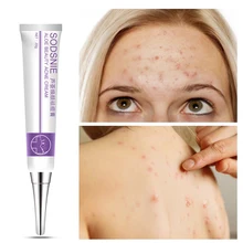 20g Acne Treatment Blackhead Remova Anti Acne Cream Oil Control Shrink Pores Acne Scar Remove Face Care Whitening