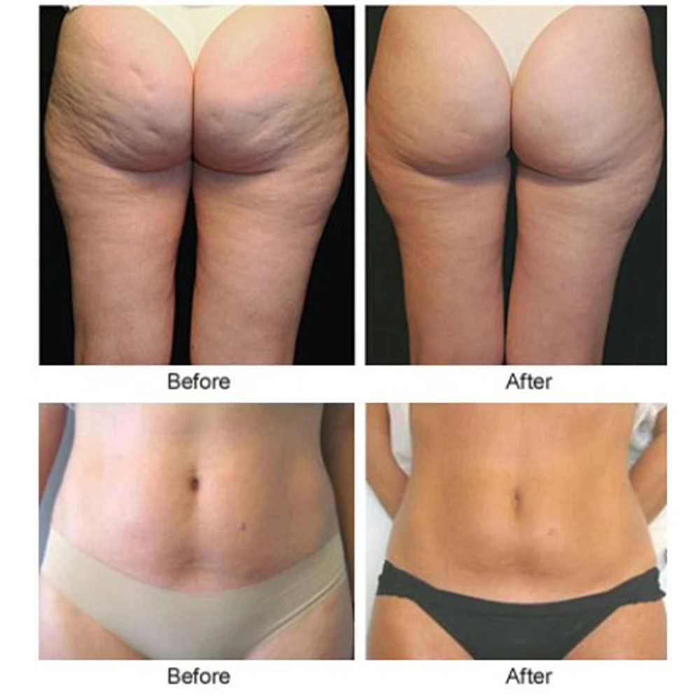 Neutriherbs Slim Patch Cellulite Reduce Losing Weight Belt Detox Body It Works To Stretch Marks Removal Weight Loss Firming Skin Marks Remover Stretch Marksmarks Cream Aliexpress