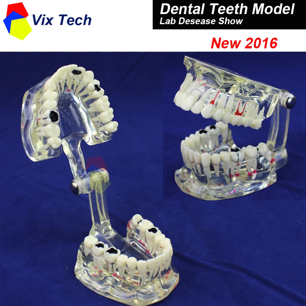 

New 2016 Dental Teeth Model Implant Disease, Restoration Bridge show for Medical Science Teaching, Tooth Lab Dentist Instrument