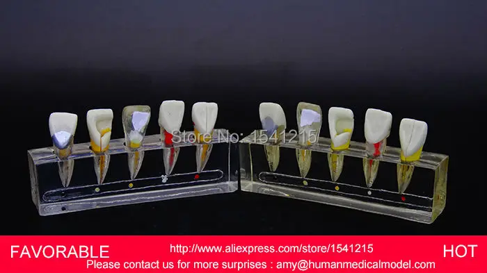 

TOOTH DISEASE PATHOLOGICAL ANATOMICAL MODEL OF TEETH CARIES GINGIVAL MEDICAL ,ENDODONTICS DENTAL MODEL DEMO 1-GASEN-DEN047