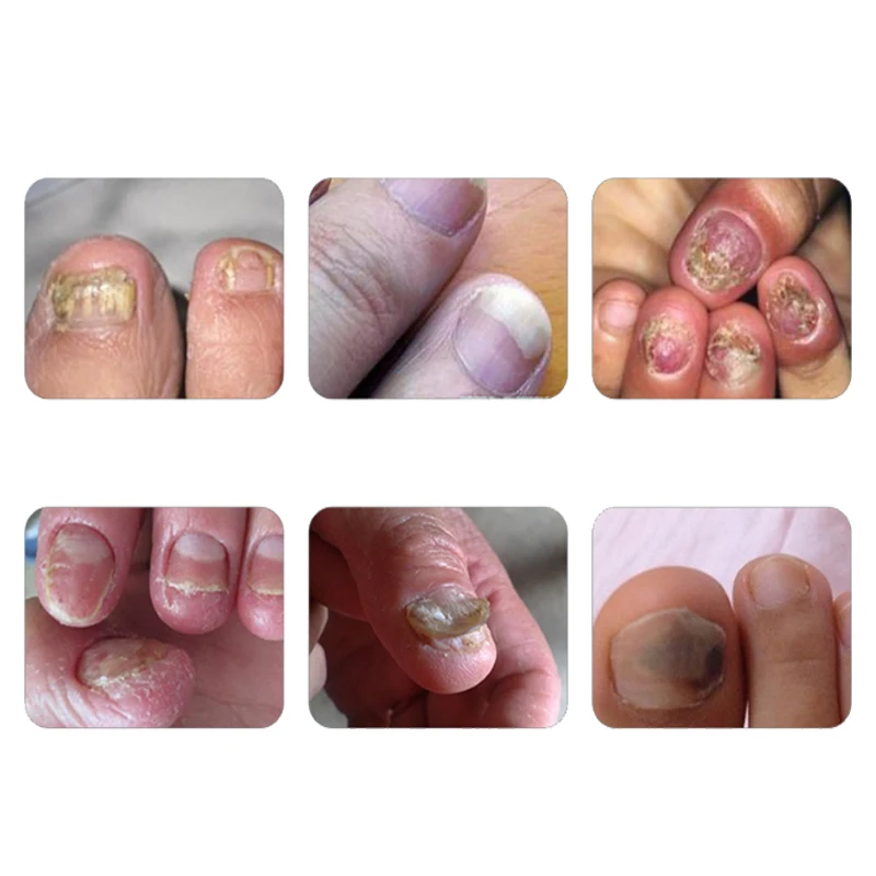 Высокое качество 10 мл ногтей грибковых лечении ног протектор крем для ногтей гриб травы ногти ремонт крем уход за ногтями Инструменты