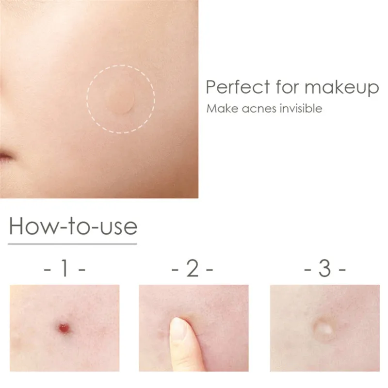 acne04_300x