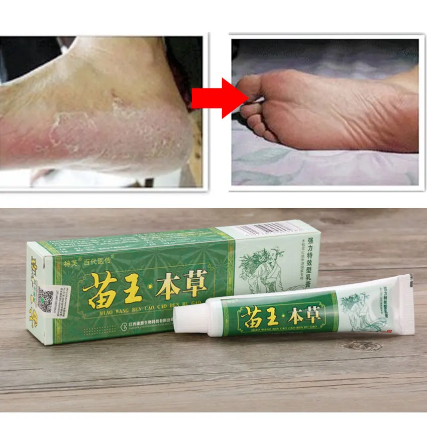 Psoriasis Cream Anti Itch Eczema Ointment Treatment Beriberi Foot Itch