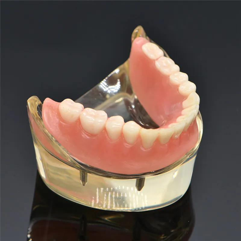 Mandibulares com Implante de Dente Modelo Teeth Dental Overdenture Removível Interior Mandibular Inferior Estudo Ensino Modelo Dentes 11 Modelo de Ensino Dental