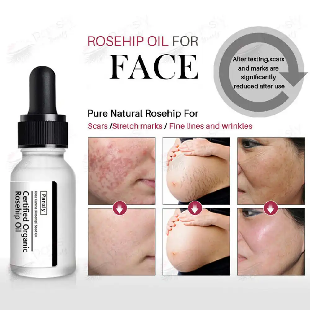 acne mild moisturizer