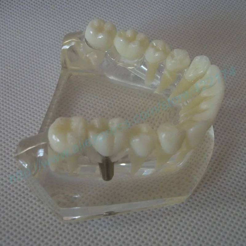 Implant model with bridge and caries 4