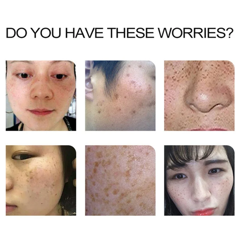 15 г для удаления меланом Acne пятна пигмент меланин темные пятна крем 1 шт. сильные эффекты мощный крем для отбеливания веснушек Новый