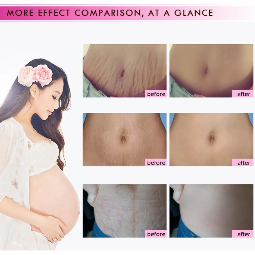 40 ml RtopR Mango quitar cicatrices de embarazo Crema para el acné tratamiento de reparación Anti-envejecimiento Anti caracoles reafirmante cremas para el cuerpo TSLM2