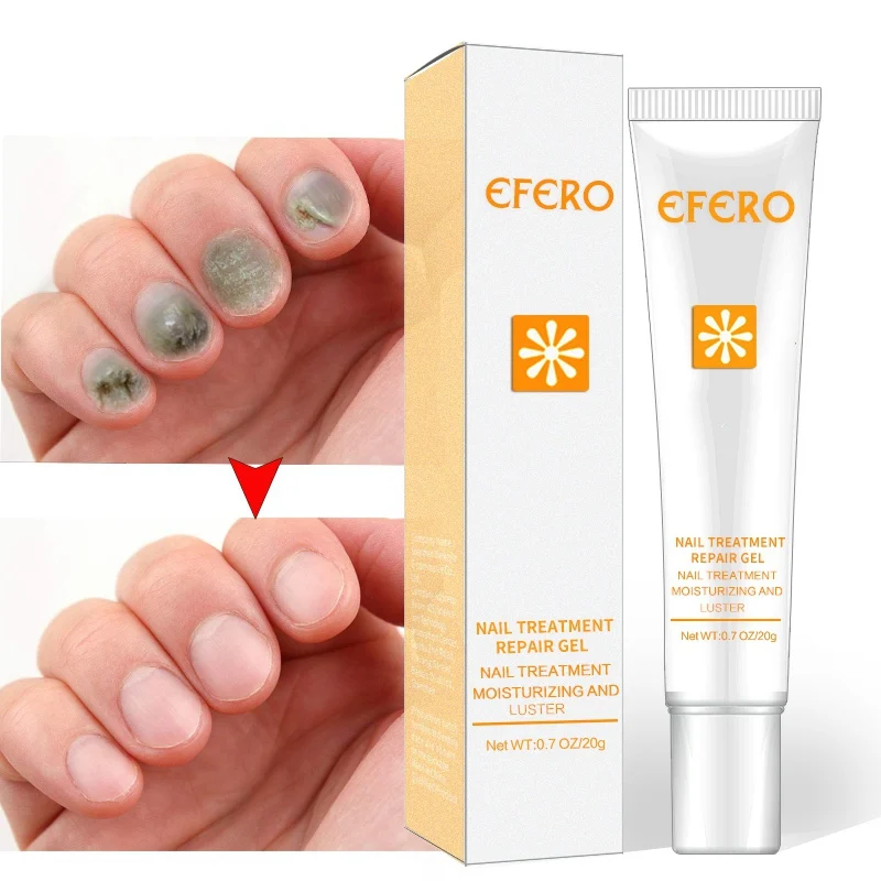 20g Nail Care Tools Anti Toenail Fungus Nails Nourishing Cream Nail Treatment Hand Foot Protector Nails Repair Serum