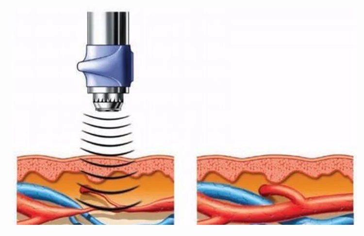 Электромагнитная ударная волна/шоковая волна терапия оборудование Физиотерапия снимает телесная боль SW13