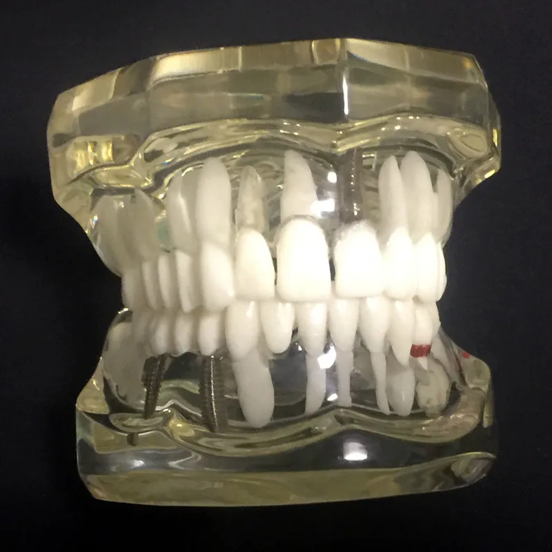 Зубные имплантаты заболеваний зубов Модель с восстановлением мост прикуса Ортодонтическая модель для медицинских наук зубные исследования