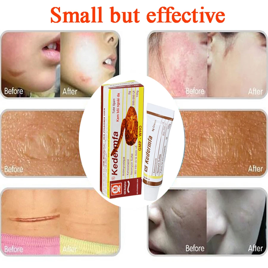 

Vietnam Remove Scar Cream Remove Acne Spots Remove Striae Gravidarum Pigmentation Corrector Anti-Aging Moisturizing 5ml