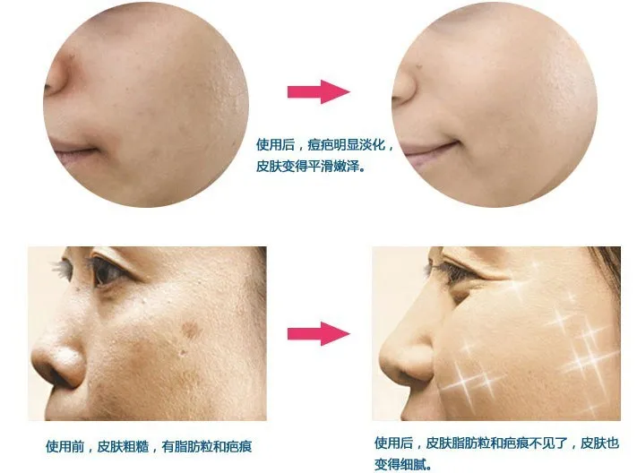 Tibet Safflower Oil Control Anti Acne Essence Cream Anti Pimple Acne Spots Shrink Pores Effective In 7 Days Acne Spots Shrink Poresoil Control Aliexpress
