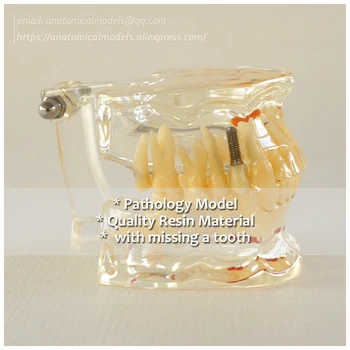 

DH/13057, Dental Pathology Model with a Missing Tooth, Medical Science Educational Teaching Anatomical Models