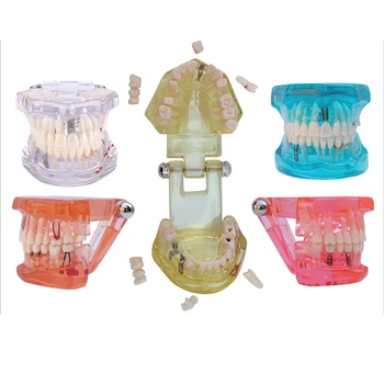 

1PC Dental Educational Pathology Comprehensive Treatment of Pathological Clear Study Model with Implant Restoration with Implant