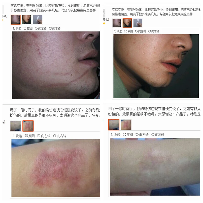 scar removal,Lavender essential oil scar cream acne India ...