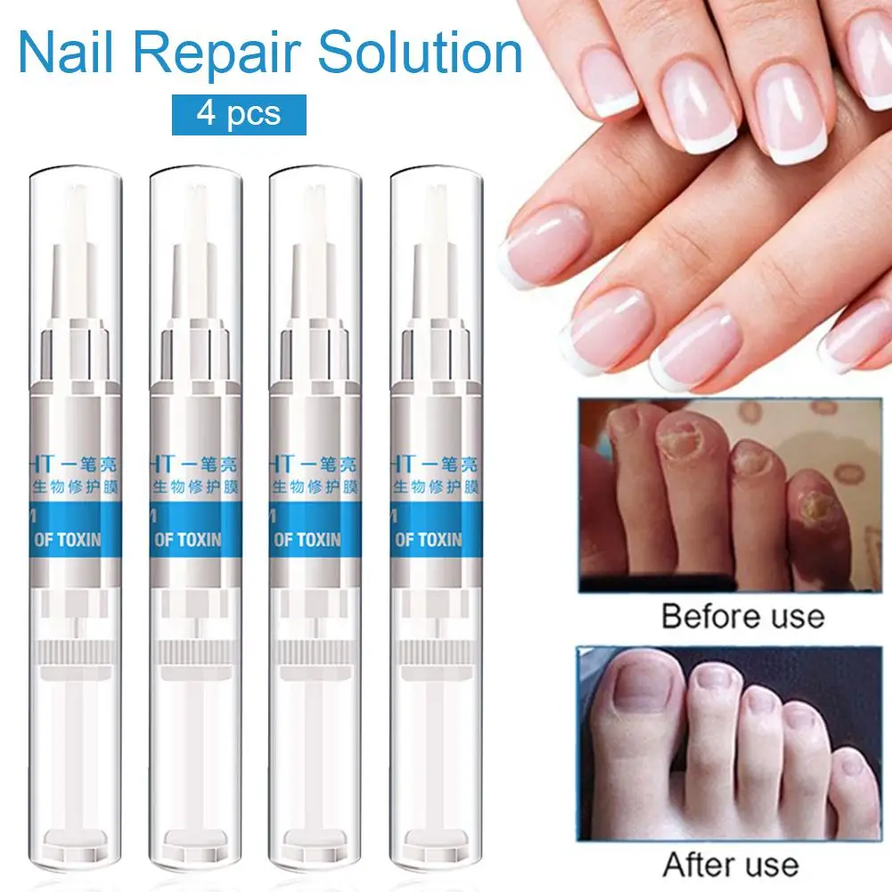 

3ml*4 Fungal Nail Treatment Essence Nail Foot Whitening Toe Nail Fungus Removal Feet Care Nail Gel For Onychomycosis