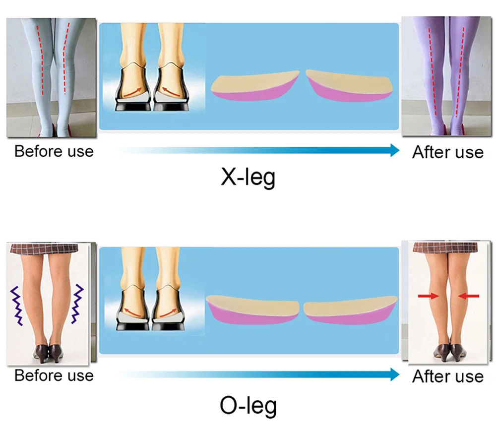 Sunvo силиконовые гелевые ортопедические стельки пяточные колодки для корректной O/X вальгусной деформации ног варусные каблуки чашки ортопедическая обувь колодки ноги боли вкладыши