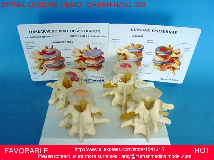

LUMBAR MODEL SPINAL NERVE MODEL CAUDAL EQUINA NERVE LUMBAR SPINE DISC MODEL SPINE SPINAL LESIONS DEMONSTRATE -GASEN-RZGL033