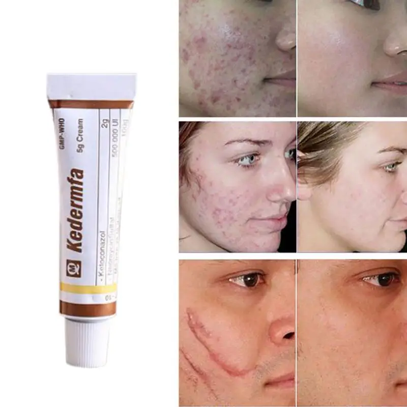 

Kedermfa Skin Scar Erasing Cream snake oil for skin Acne Scar Removal Cream anti-inflammatory Skin Care Pigmentation Corrector