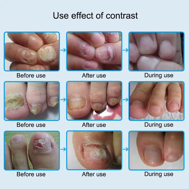 Улитки удаляют эфирное масло поврежденные ногти смягчающие для лечения рингчервя гриб онихомикоз 669