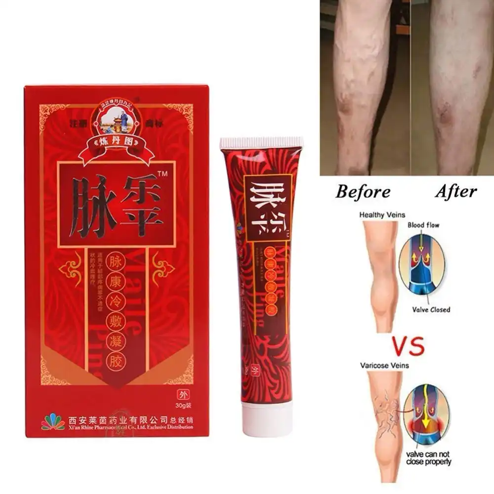 crema de casă de la varicoză varicoză preparate de tratament pelvis