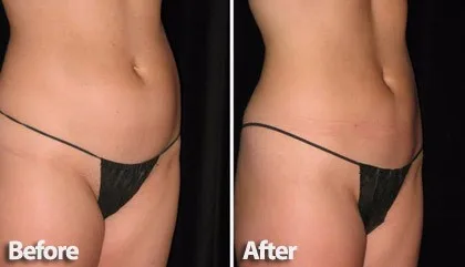 cool-lipo-before-after-photo-tummy