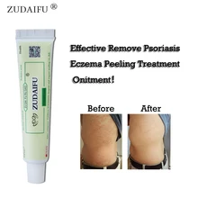 20 шт. ZUDAIFU псориаз, дерматит, Eczema Pruritus проблемы с кожей крем с розничной коробкой Прямая поставка и