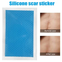 Высококачественный силиконовый шрам терапевтический стикер для удаления травм ожога силиконовый пластырь многоразовый гель от угрей ремонт кожи MD99