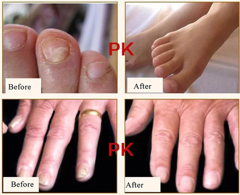 Брендовая защита ноги крем для ухода за кожей 15 г Лечение грибка для ногтей трав крем для ремонта ногтей