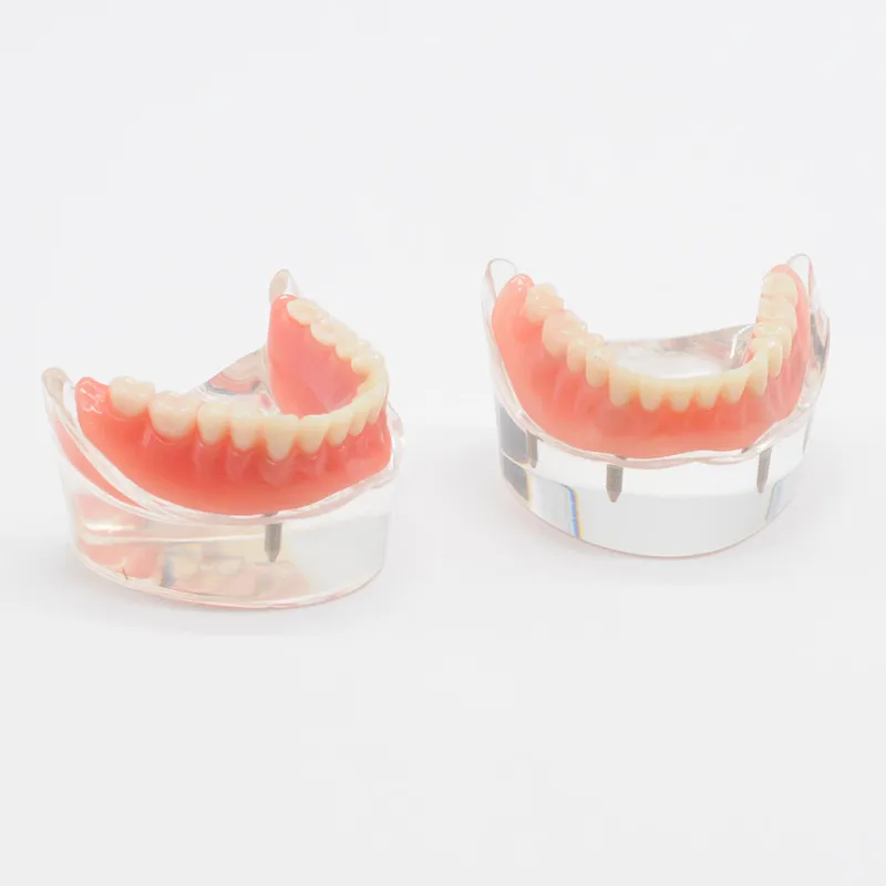 Mandibule Inférieure De Dentiste Avec Implants 2/4, Modèle D'Apprentissage
