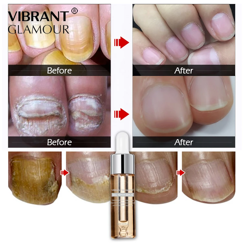 Восстанавливающая эссенция для ногтей, сыворотка для лечения грибковых ногтей, удаление онихомикоза, уход за ногтями и ногами, восстанавливающее жидкое эссенционное масло TSLM1