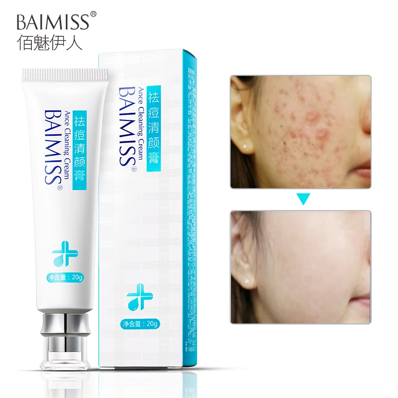 Baimiss Acne Treatment Cream Anti Remover Facial Skin Care Repair Comedone Pimple Quickly Natural Herbal Remove Scar Gel huismerk kopen in de aanbieding Baimiss Acne Treatment Cream Anti Remover Facial Skin Care Repair Comedone Pimple Quickly Natural Herbal Remove Scar Gel huismerk kopen in de aanbieding
