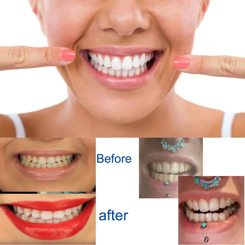Teeth Whitening (1)