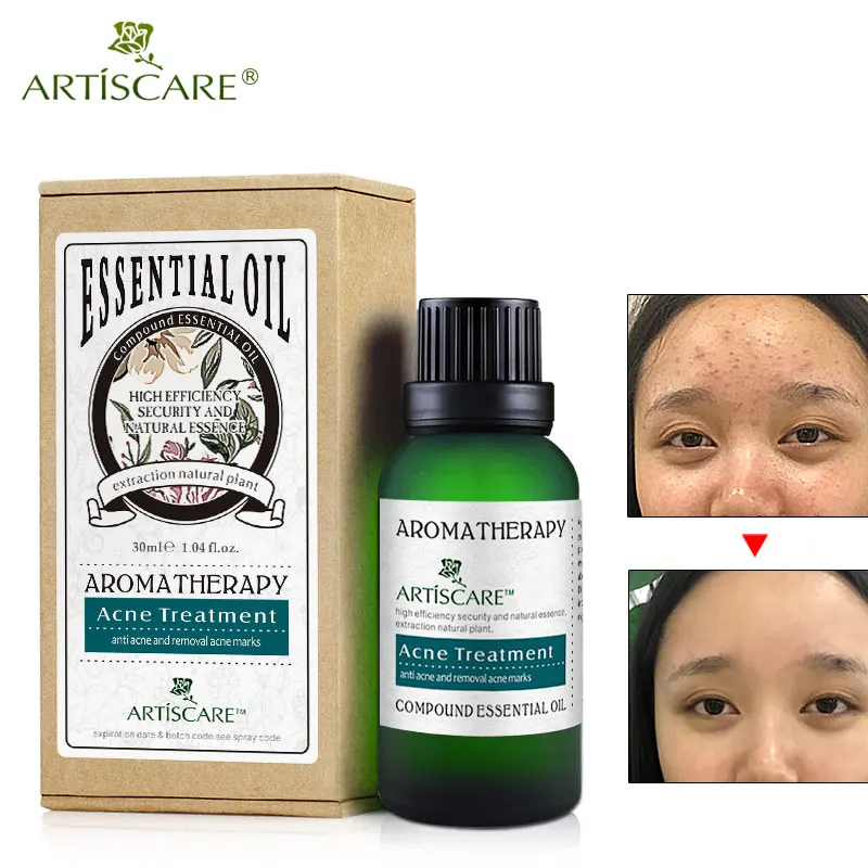 ARTISCARE Acne Treatment Essential Oil 30ml Anti Acne Removal Scars