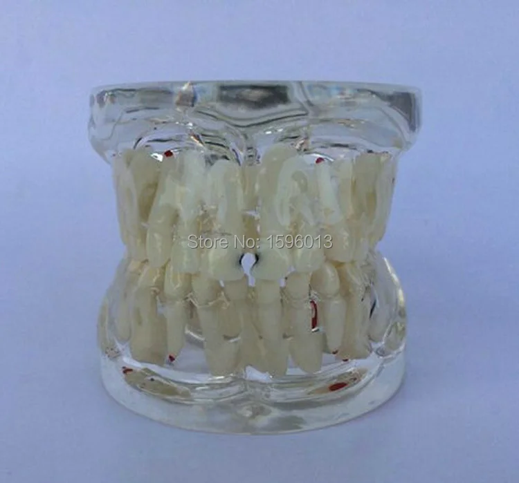 

Transparent Milk Teeth Pathology Model, deciduous teeth pathological model