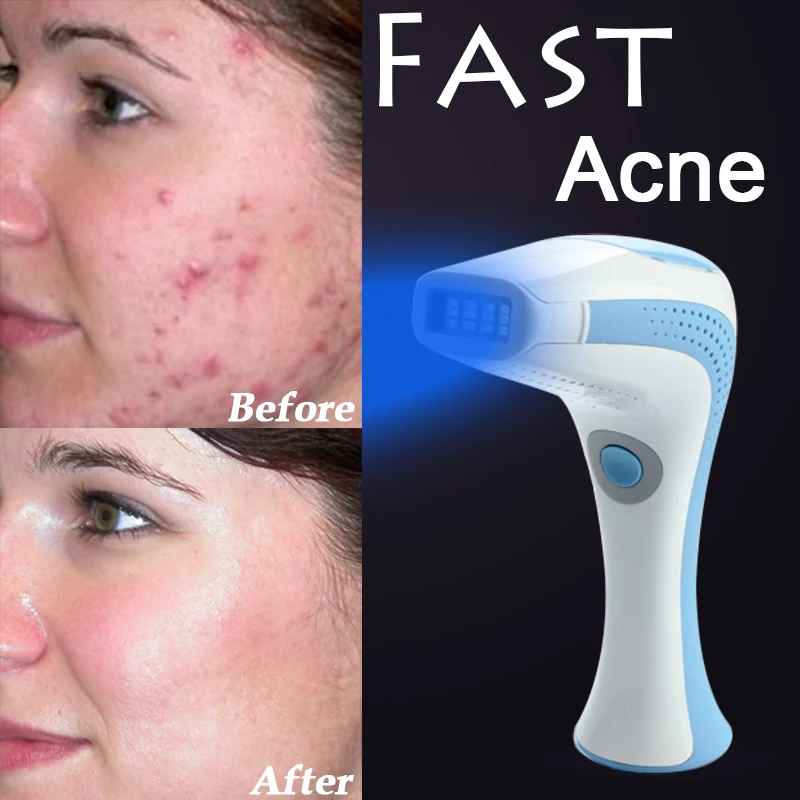 treating facial acne teen boy cums on abs